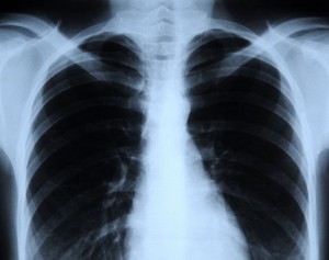 Photography Credit: Fotokon | Dreamstime "Chest X-Ray"